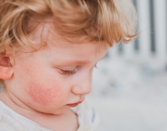 food allergy young child cheeks