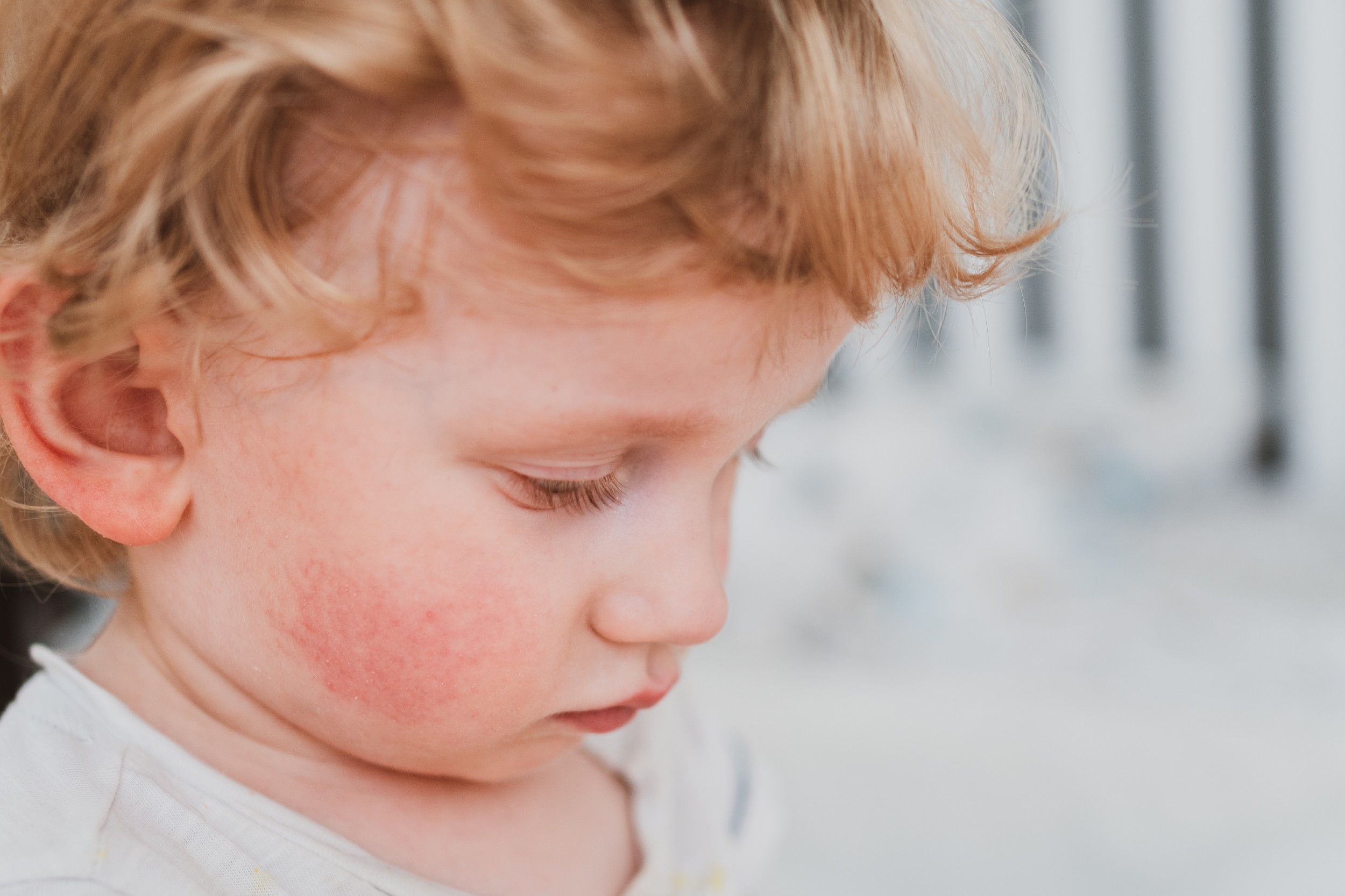 Rujeola: Ce este, de ce este atât de contagioasă și ce vaccin oferă protecția eficientă împotriva bolii